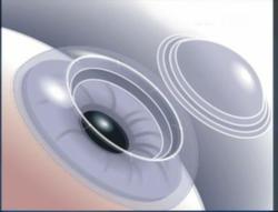 laser corneal transplant Utah